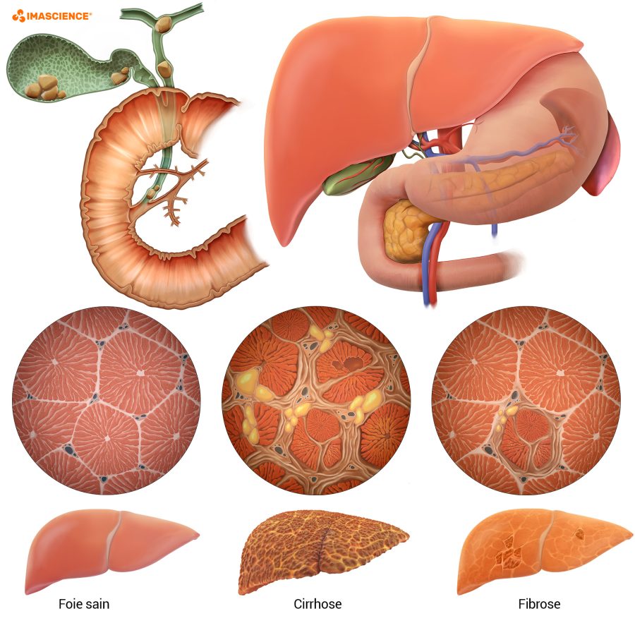 Illustration médicale — anatomie du foie : cirrhose et fibrose