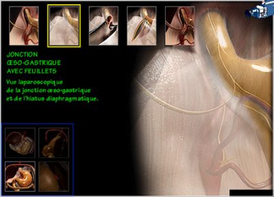 Digestive surgery - gastroesophageal junction with layers