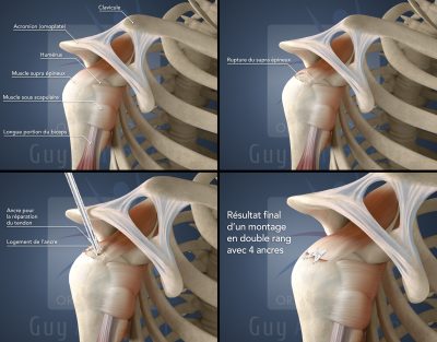 Guy Amsallem - Orthopaedics - Supraspinatus reconstruction