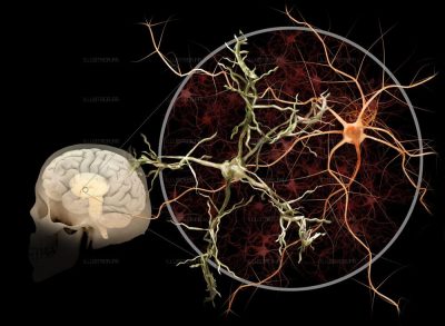 Pour La Science. Huntington's disease 3