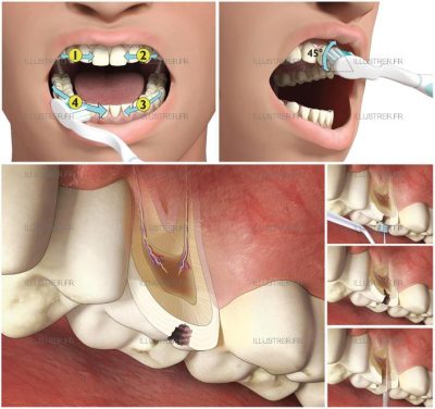 Listerine. - Dental care