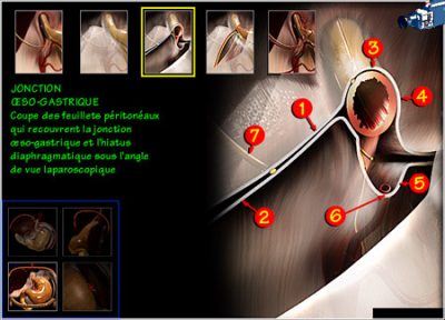 gastroesophageal junction, digestive surgery