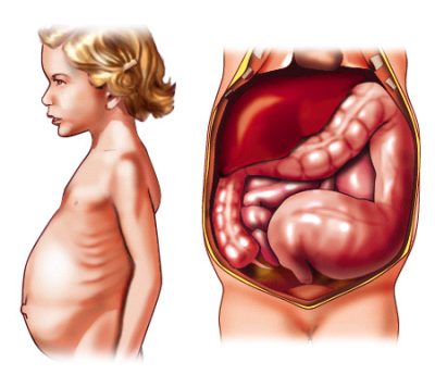 Medical CD-ROM on digestive surgery - megacolon