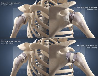 Guy Amsallem - Orthopaedics - Shoulder prostheses