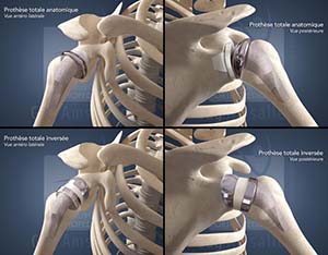 Guy Amsallem - Orthopédie - prothèses épaule